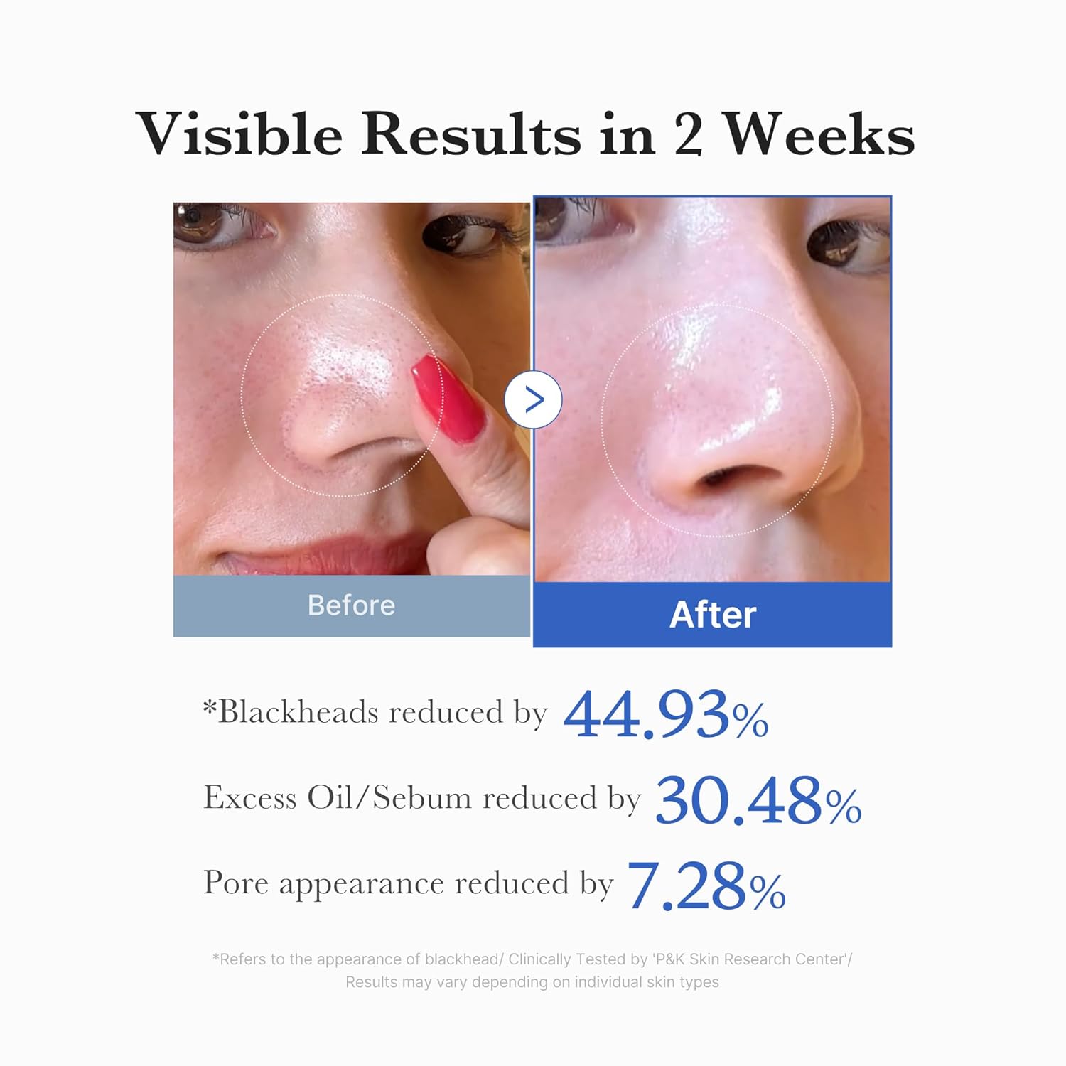Clinical 2-week sebum and pore clearing results using Medicube toner pads